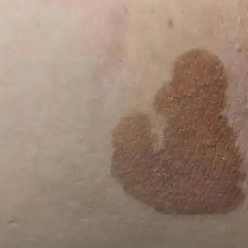 大腿根有褐色圆形斑