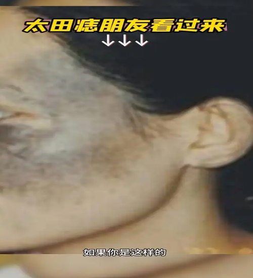 太田痣多大年龄治最好