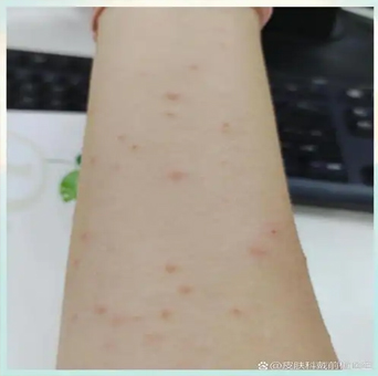 女人身上有血管瘤的原因