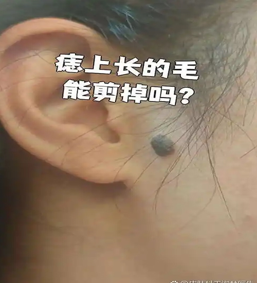 黑色素沉着怎么去除