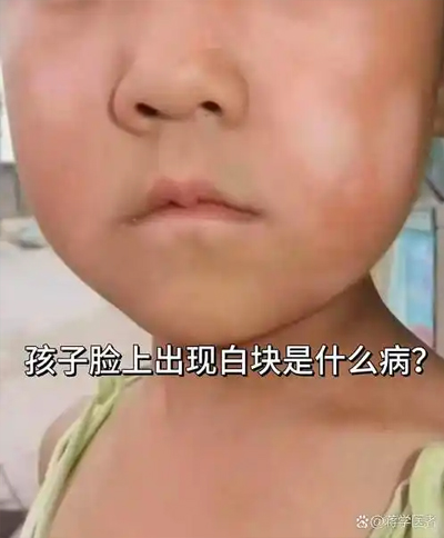 胎记有白色的吗