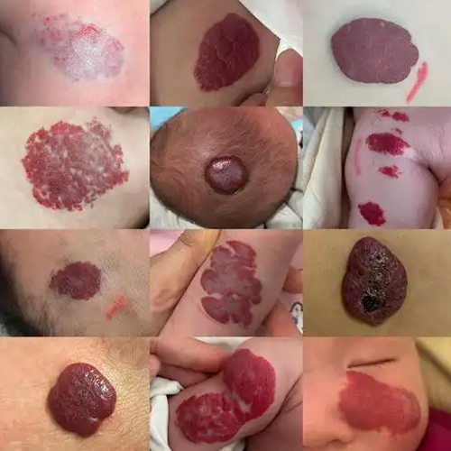 什么是血管瘤严重吗