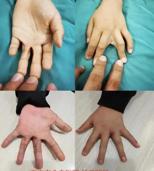混合畸形率多少就正常