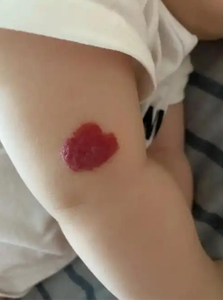 血管瘤危险吗