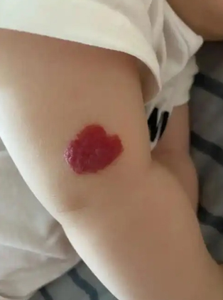 血管瘤危险吗