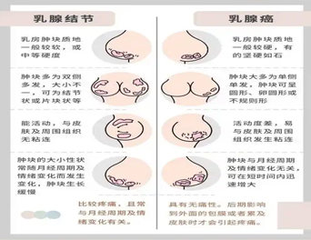 乳腺疾病有哪些类型