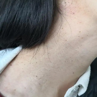 身上不知不觉长黑点