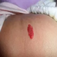 当心！宝宝身上的小红点，有可能是血管瘤！