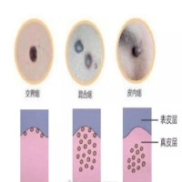医生有话说︱人各有“痣” 色素痣到底该不该祛除？