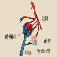 山西长峰血管瘤医院——血管畸形诊疗的专业力量