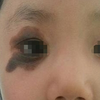专家带您了解这种“青色胎记”及其治疗