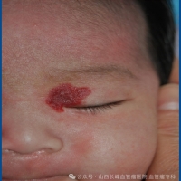 关于胎记与血管瘤：你需要了解的知识都在这