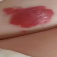 发现宝宝有血管瘤，你是否还在等待？