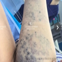 血管瘤不可怕，国内权威专家申刚教授将于9月27日来院会诊并开展治疗