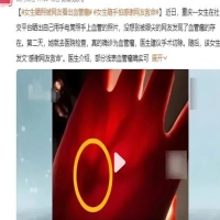 网友“神眼”！“女生晒照被看出血管瘤”，专家提醒：有这些信号速查！ 