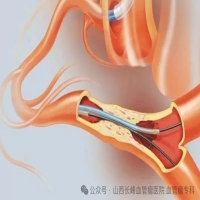 医疗技术 | 不开刀，不切除——介入治疗你了解过吗？